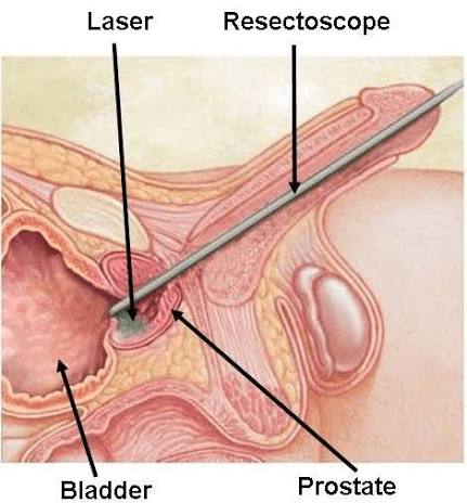 Laser Ablation for Thyroid Nodules: How It Works, Benefits & Recovery images 38