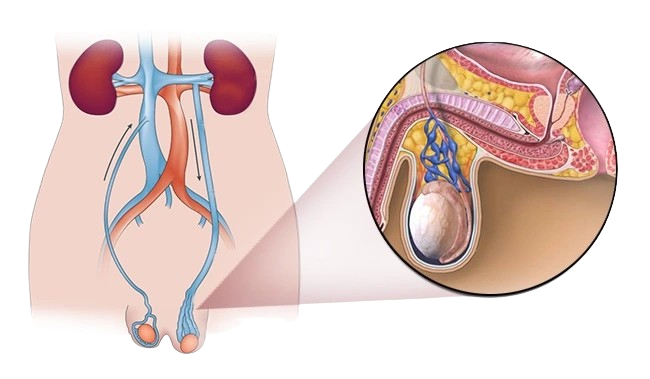 Varicocele Embolization for Infertility: Does It Improve Fertility? varicocele embolization removebg preview 1