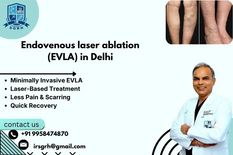 Endovenous laser ablation (EVLA) in Delhi