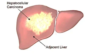 liver-cancer2