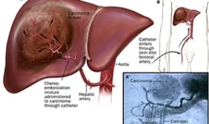 liver-cancer3