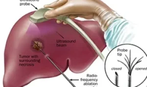 liver-cancer4